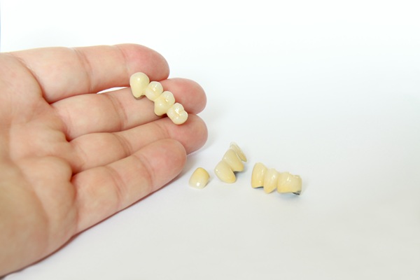 How Often To Replace A Dental Bridge And How To Extend Its Lifespan