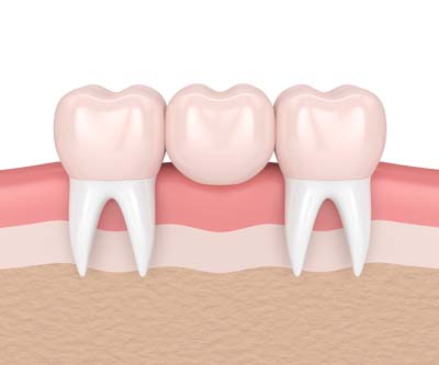Getting A Dental Bridge: What Is The Process?