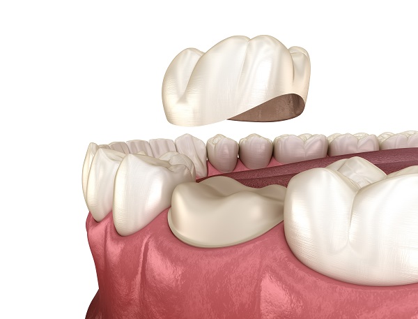 How To Extend The Life Of Your Dental Crown