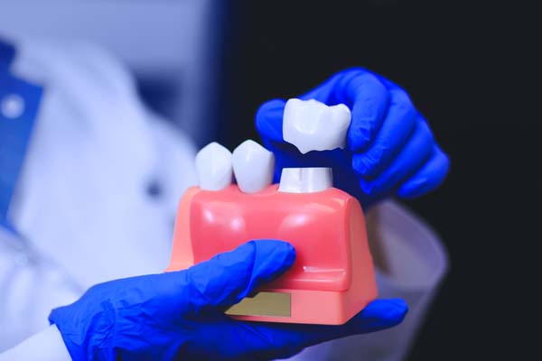 Questions To Ask Your Dentist About Dental Crown