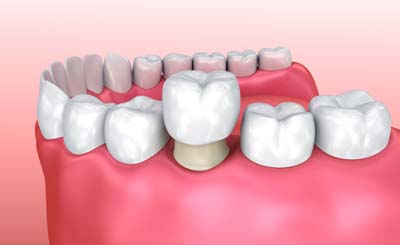 Dental Crowns and Dental Bridges Milwaukee, WI