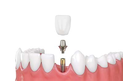 Implant Dentist Milwaukee, WI