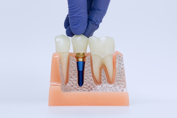 Common Signs Of Gum Disease Around Dental Implants