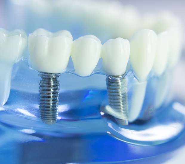 Milwaukee Dental Implants