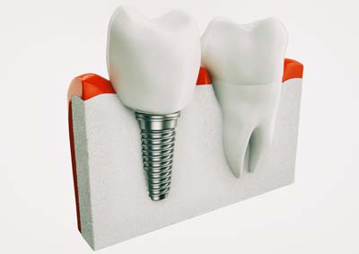 Dental Implants Milwaukee, WI