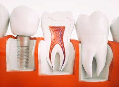 Dental Implants Milwaukee, WI