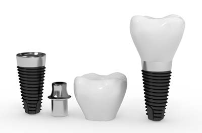 Dental Implants Milwaukee, WI