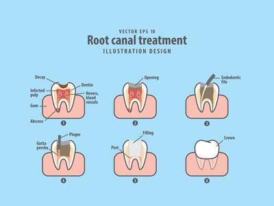 Can My Tooth Be Saved? An Endodontist Might Be The Answer