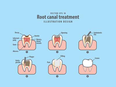 Endodontic Surgery Milwaukee, WI