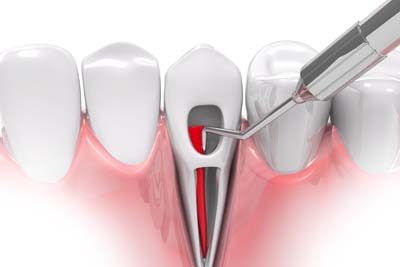 Endodontic Surgery Milwaukee, WI