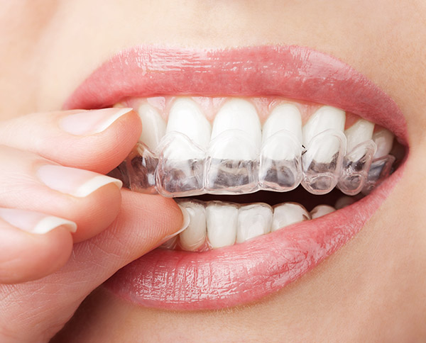 Is Invisalign® The Best Option For Me?