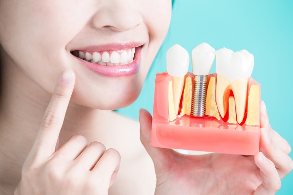 mini dental implant Milwaukee, WI