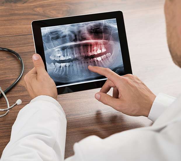 Milwaukee Types of Dental Root Fractures