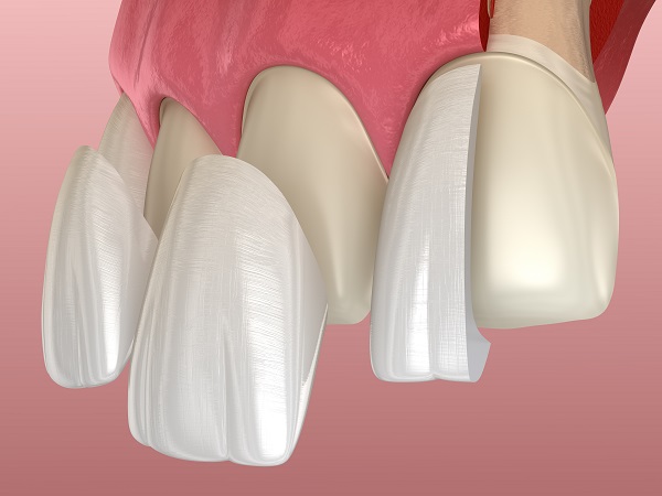 Learn About A New Smile Using Dental Veneers